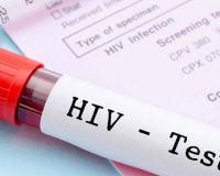 در مبتلایان به HIV ابتلا به کووید ۱۹ کم است