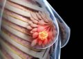 کشف جدیدی برای درمان سرطان پستان مقاوم به درمان «سه منفی»