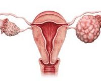 کشف عامل جدید گسترش سرطان تخمدان