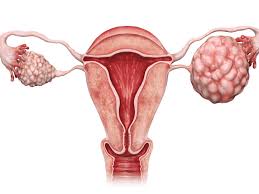کشف عامل جدید گسترش سرطان تخمدان
